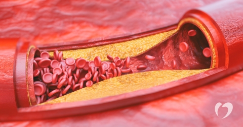 1-2018-July-15th---Atherosclerosis.jpg