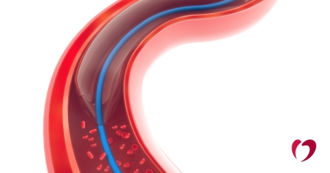 1-2018-September-15th---AngioplastyStents.jpg