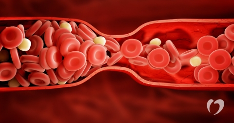 1B-2018-June---Deep-Vein-Thrombosis.jpg