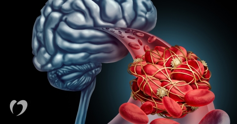 TIA-Transient-Ischemic-Attack-Oklahoma-Heart-Hospital.jpg