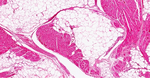 myocardial-fibrosis-oklahoma-heart-hospital.jpg