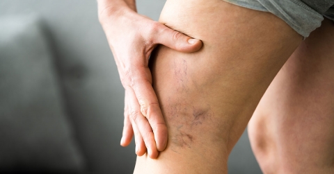 treatments-for-vein-disease-oklahoma-heart-hospital.jpg