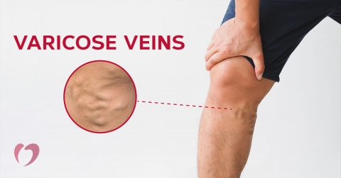 varicose-vein-stripping-what-to-expect-oklahoma-heart-hospital.jpg