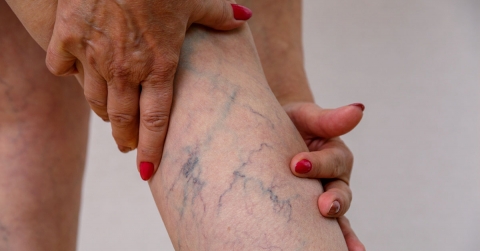 varicose-veins-causes-symptoms-treatment-oklahoma-heart-hospital.jpg