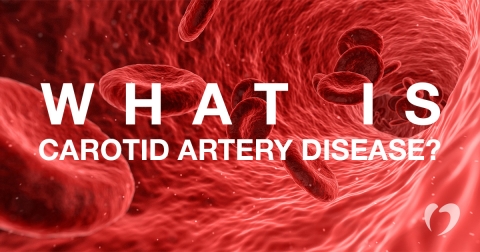 what is carotid artery disease.jpg