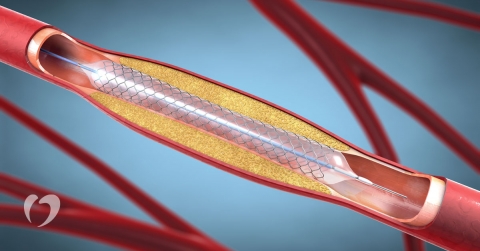 what-to-expect-during-after-stent-placement-oklahoma-heart-hospital.jpg